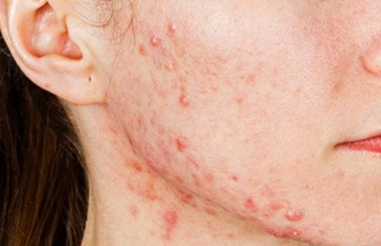 Acne Vulgaris