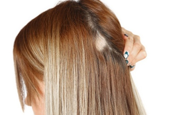 Alopecia