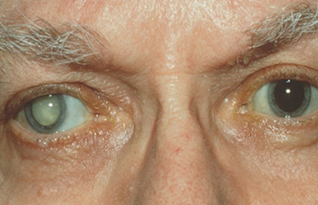 CATARACT