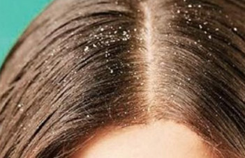 Dandruff