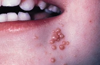 Molloscumcontagiosum