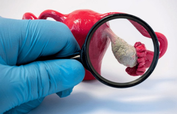 PCOD � POLY CYSTIC OVARIAN SYNDROME