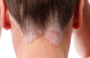 Psoriasis