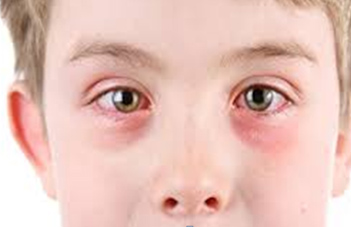  Vernalkerato conjunctivitis (VKC)