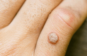 Warts