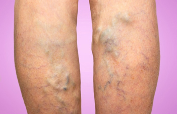 varicosevein